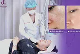 Giải mã sức hút Deep FX Laser: Công nghệ thu nhỏ lỗ chân lông thế hệ mới đang “gây bão” tại LG Clinic