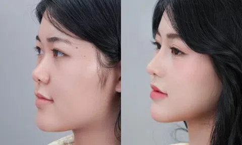 “Xóa mũi tẹt cho thanh thiếu niên Việt”: Hàng loạt bạn trẻ tự tin hơn sau nâng mũi sụn sườn J-Cos