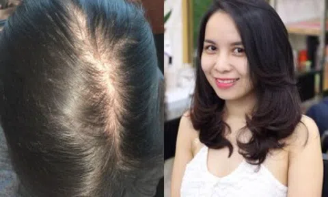 Không cần thuốc đắt tiền, phụ nữ U40 vẫn có thể sở hữu mái tóc dày khỏe nhờ 5 thay đổi trong sinh hoạt