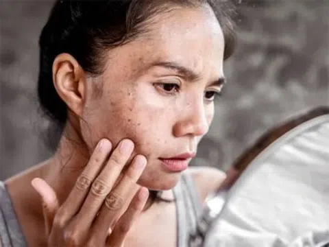 Tia UV - “kẻ phá hủy thầm lặng” khiến da già đi chóng mặt nếu không được bảo vệ đúng cách