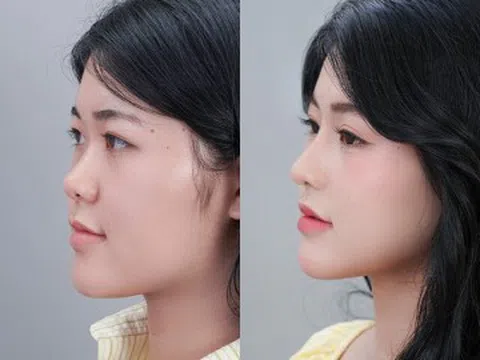 “Xóa mũi tẹt cho thanh thiếu niên Việt”: Hàng loạt bạn trẻ tự tin hơn sau nâng mũi sụn sườn J-Cos