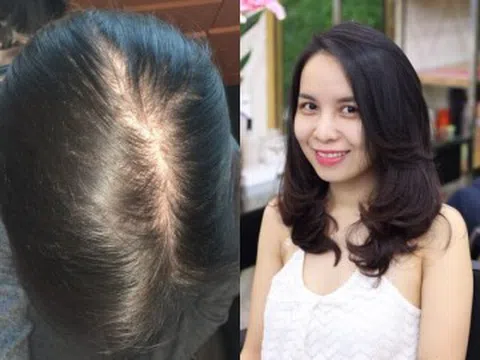 Không cần thuốc đắt tiền, phụ nữ U40 vẫn có thể sở hữu mái tóc dày khỏe nhờ 5 thay đổi trong sinh hoạt